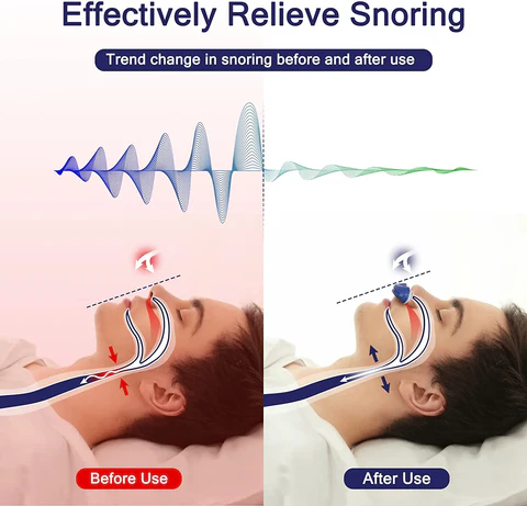 Innowacyjny mikro aparat CPAP, skutecznie eliminuje chrapanie i objawy bezdechu sennego dla lepszej higieny snu.